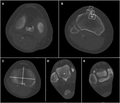 A Coronal Landmark for Tibial Component Positioning With Anatomical Alignment in Total Knee Arthroplasty: A Radiological and Clinical Study